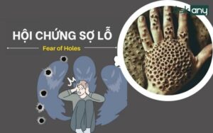 cách khắc phục lỗ lã ban đầu