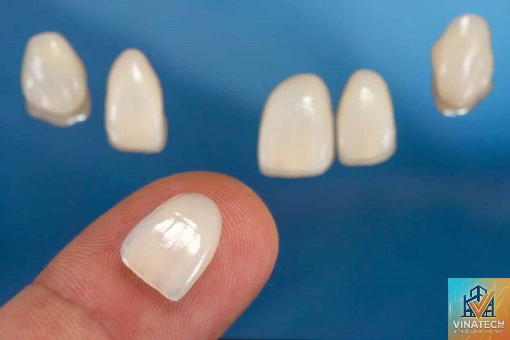 nhược điểm veneer