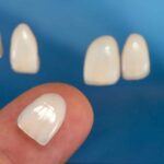 Nhược Điểm Veneer: Sự Thật Ít Ai Nói Trước Khi Bọc Răng Sứ nhược điểm veneer