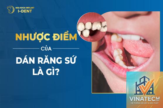nhược điểm veneer - Hình 2