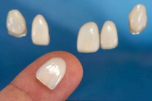 nhược điểm veneer