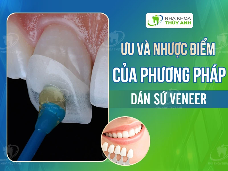 nhược điểm veneer - Hình 4