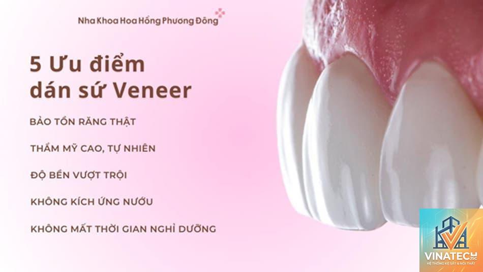 ưu điểm veneer