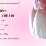 Ưu Điểm Veneer: Phân Tích Chuyên Sâu Toàn Diện Cho Nụ Cười Hoàn Hảo ưu điểm veneer