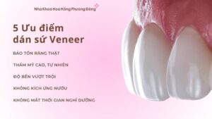 ưu điểm veneer