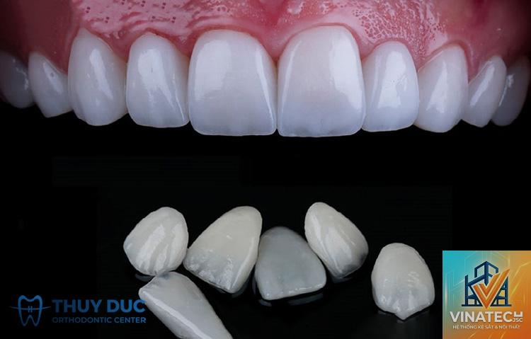 ưu điểm veneer - Hình 4