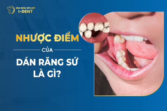 ưu điểm veneer - Hình 4
